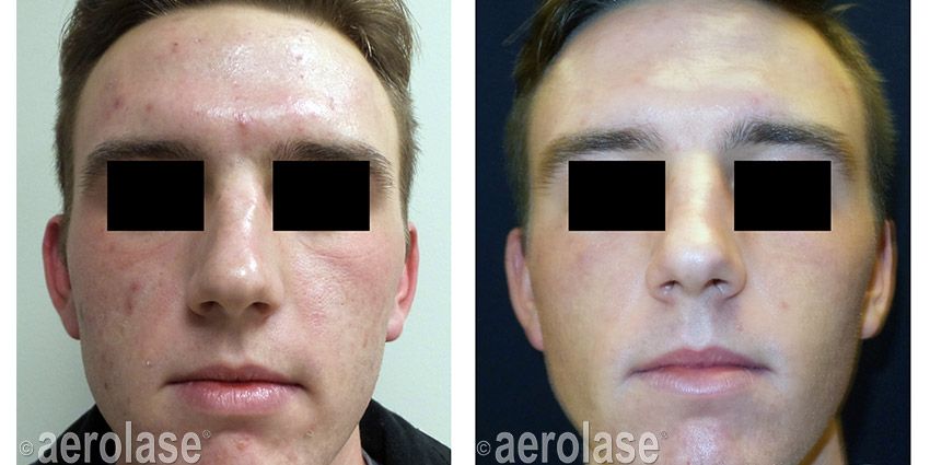 Before and after photo of a person's face. Left side: acne and redness. Right side: clear skin.