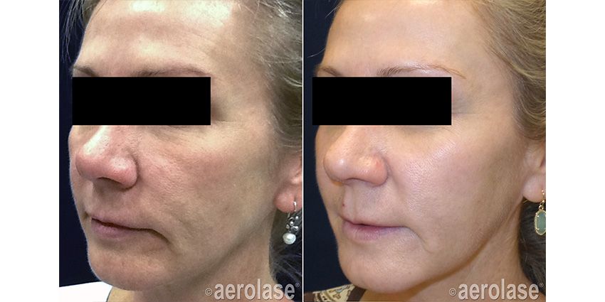 Side-by-side photos of a woman's face, before and after a skin treatment. Left side shows skin with wrinkles; right shows smoother skin.