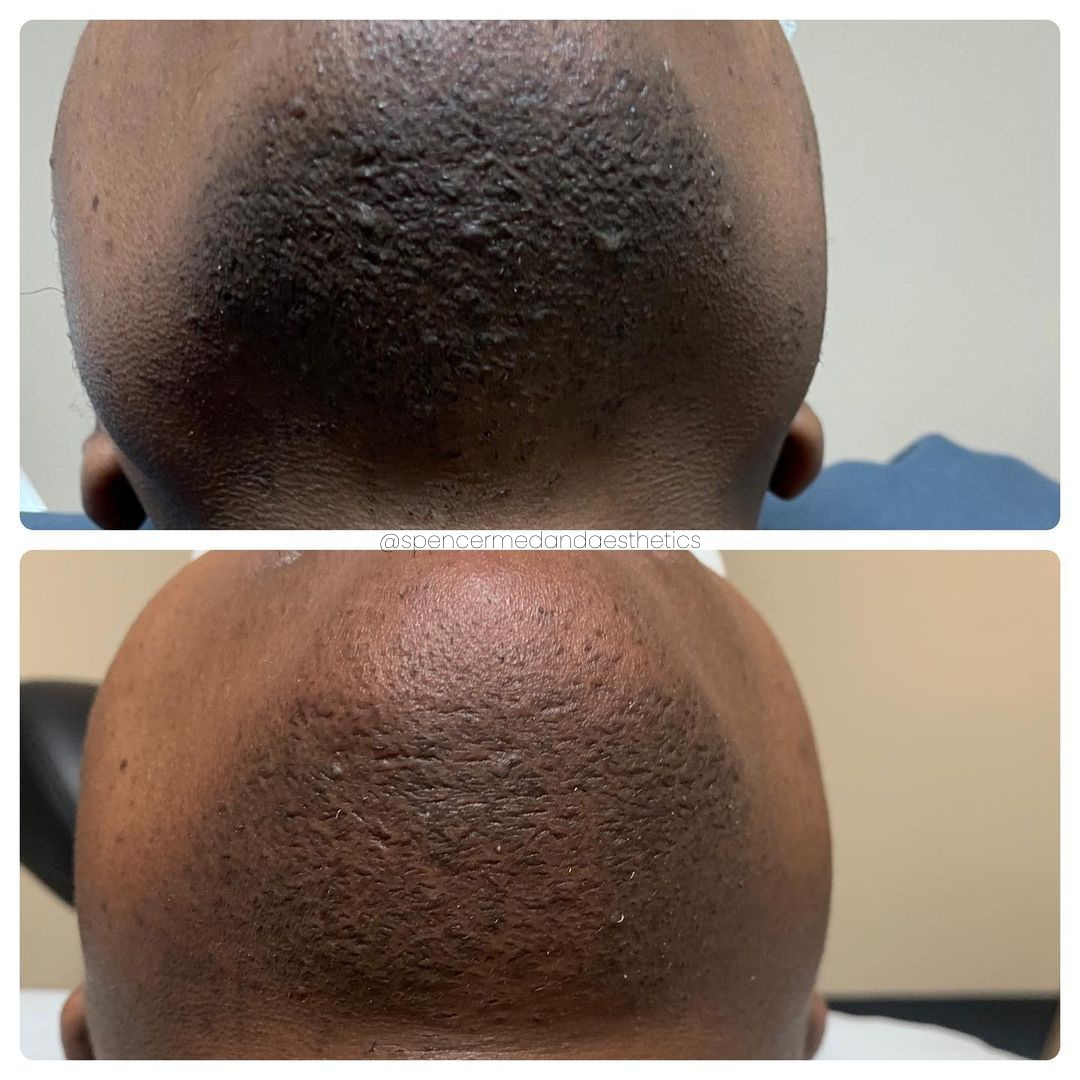 Two images of the back of a person's head: before and after treatment for skin bumps. Dark skin, indoor setting.