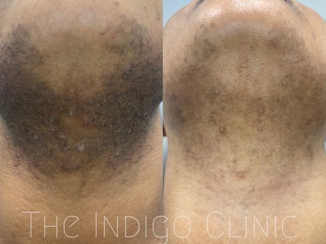 Before and after photos of a neck area showing a reduction in dark pigmentation.