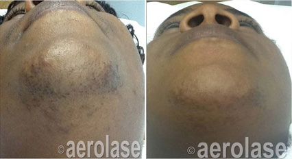 Side-by-side comparison of a person's chin before and after laser hair removal, showing reduced hair growth.