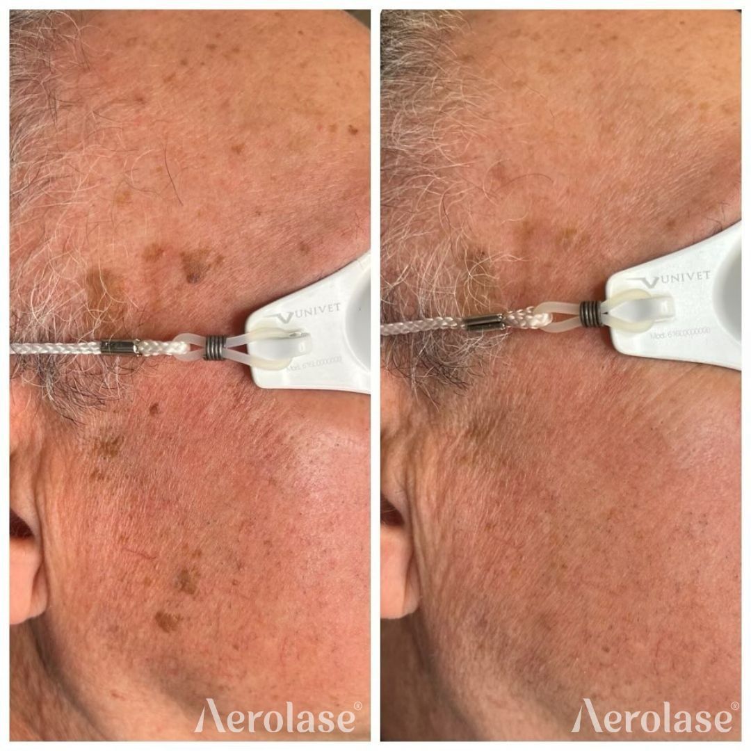 Side-by-side comparison of skin before and after Aerolase laser treatment, showing reduction in age spots and improved complexion.