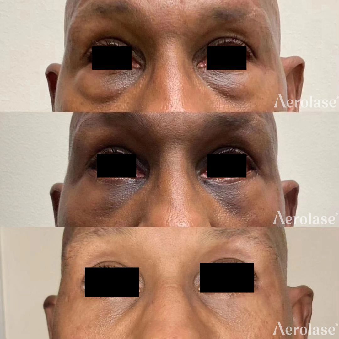 Three images of eyes; dark circles under eyes diminish after treatment.