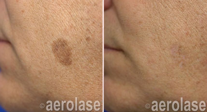 Before and after hand photos; a brown spot is significantly lighter after laser treatment.