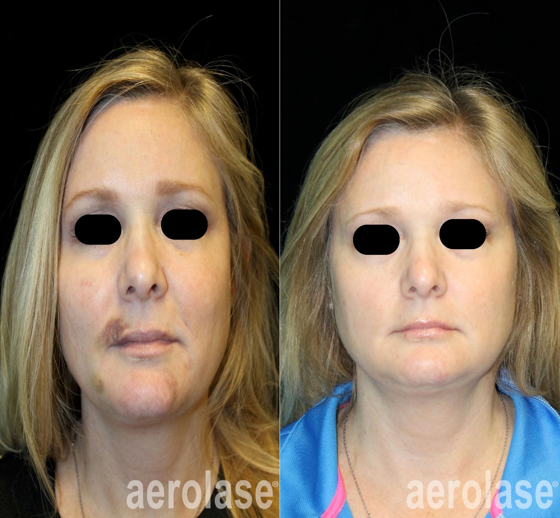 Before-and-after facial comparison: Skin with dark spots on left is lightened on the right. Both photos show a person facing forward.