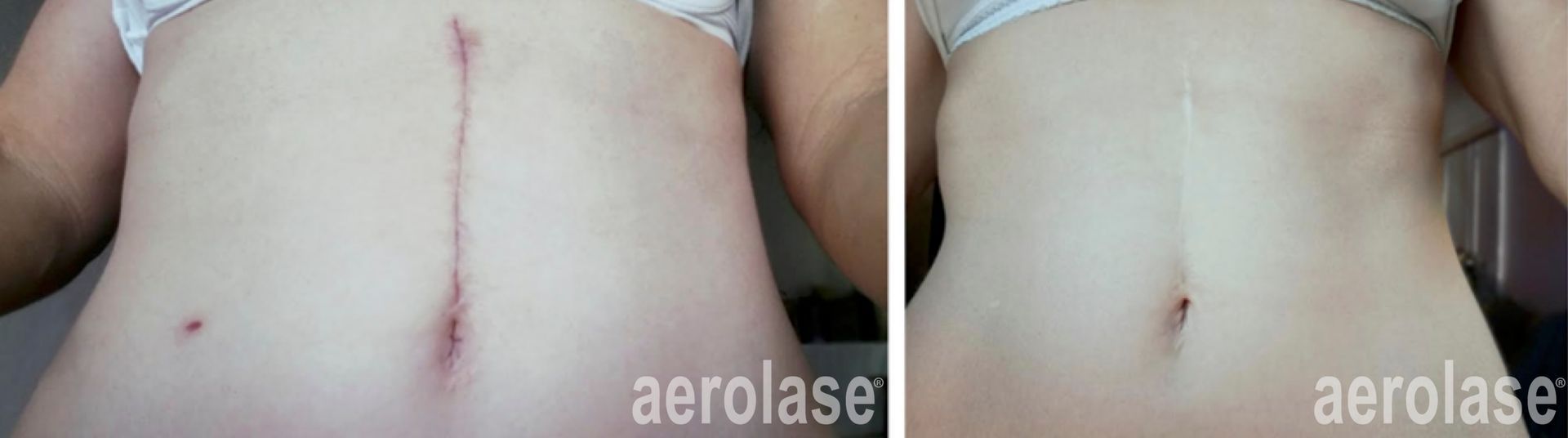Before and after abdominal scar treatment. Abdomen with visible scar before and after.