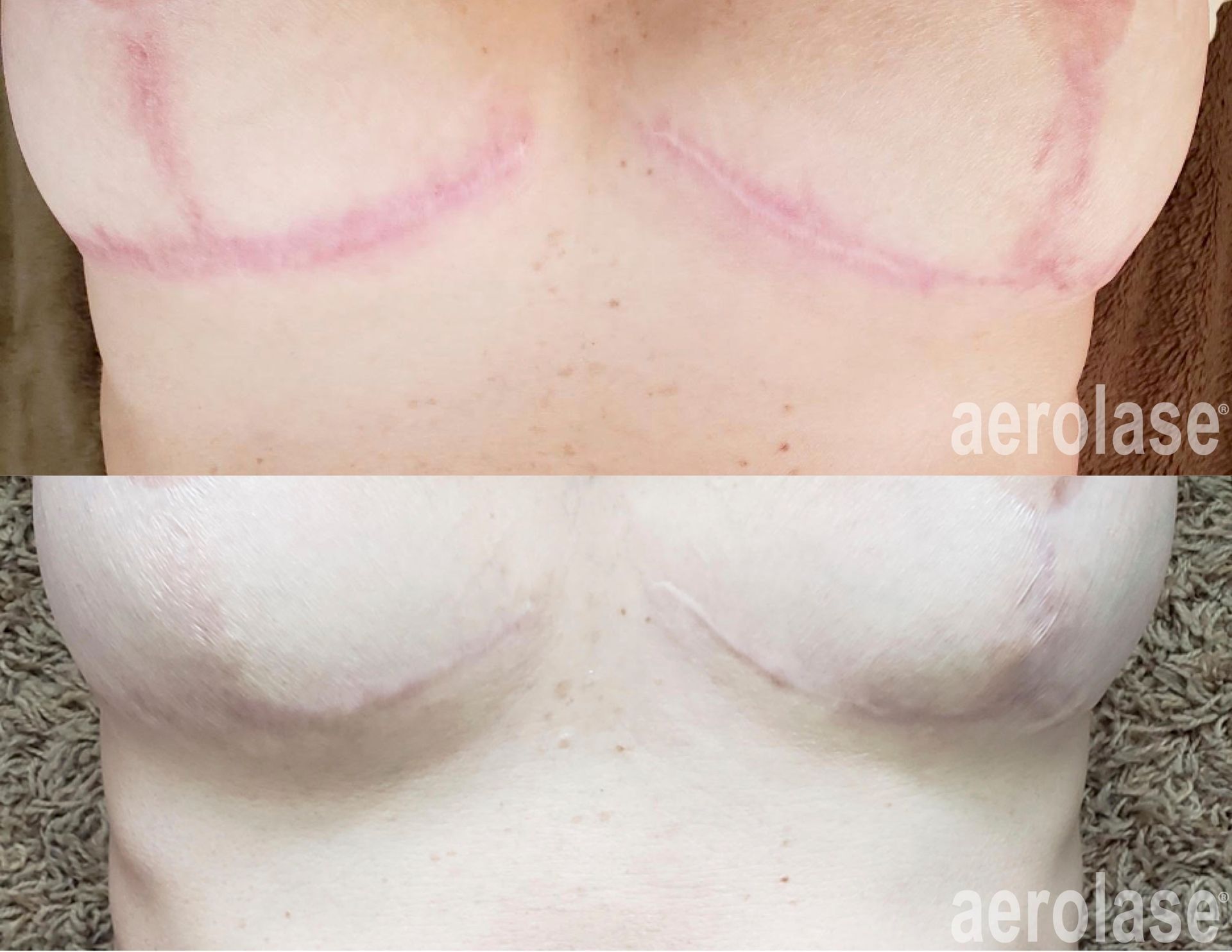 Comparison: Before and after photo of chest scars, after laser treatment to reduce their appearance.