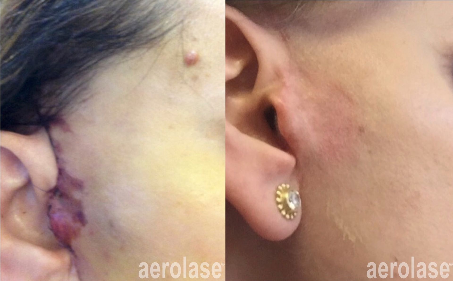 Comparison of a red, swollen ear injury before and healed after laser treatment.