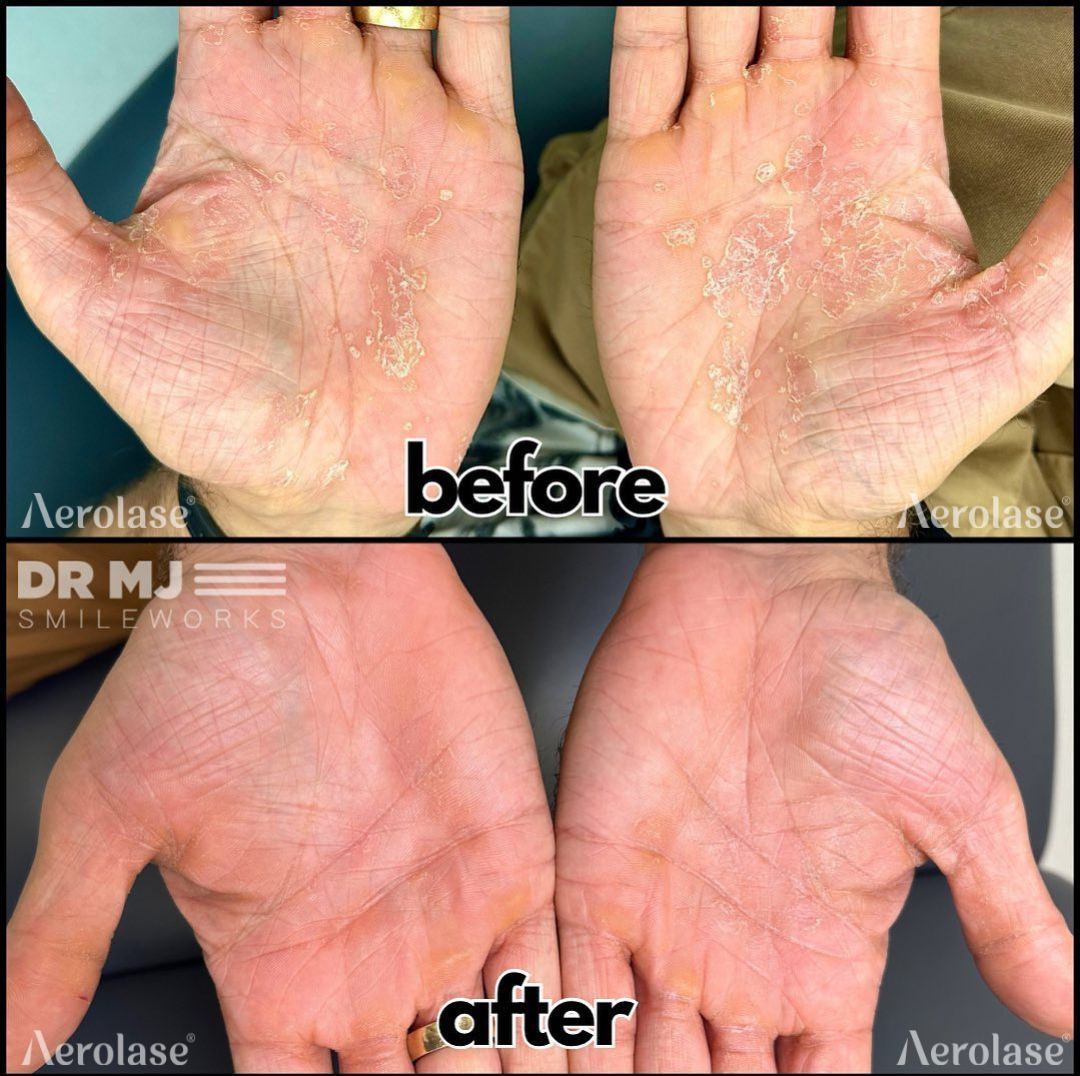Hands before and after treatment, showing skin condition improvement.