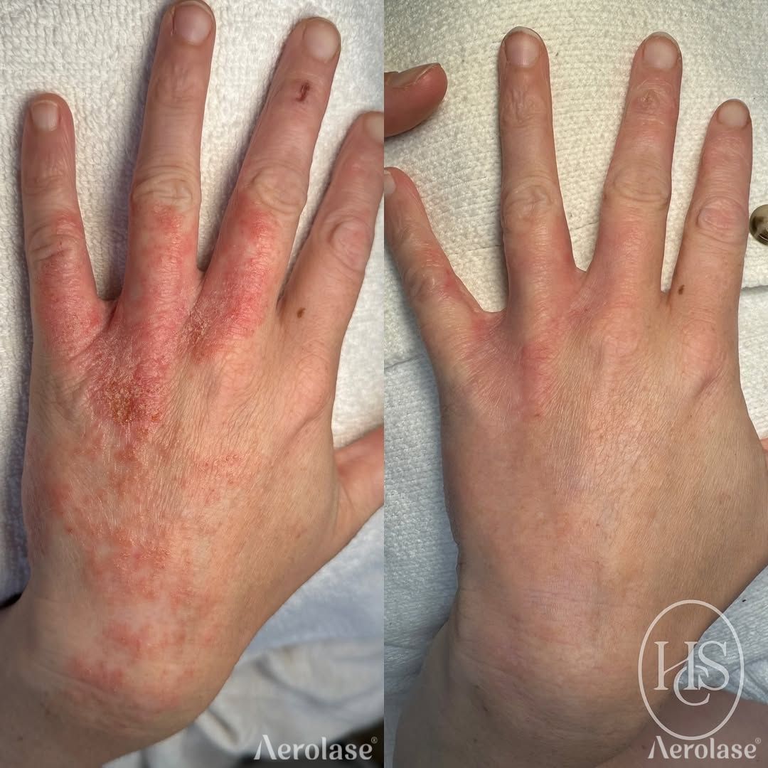 Hands showing a before-and-after of skin redness. Left hand has inflamed red skin; right hand skin is clearer. Aerolase logo.