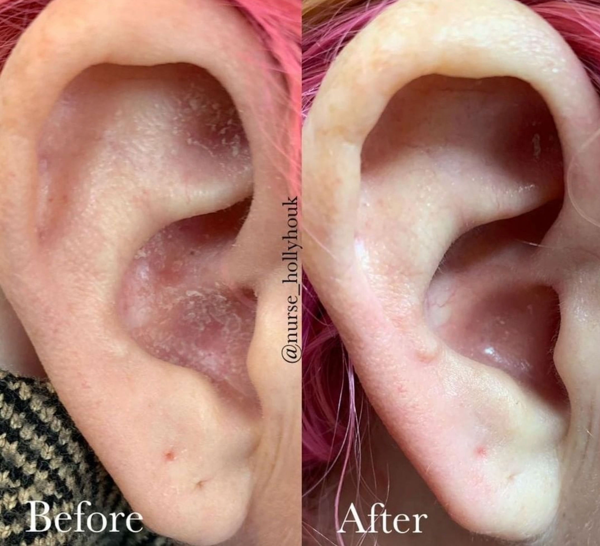 Two close-up views of an ear. Before: red, irritated skin. After: improved skin.