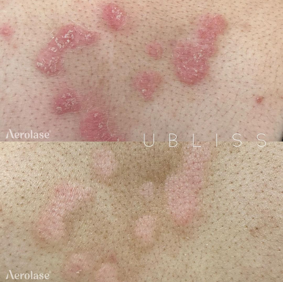 Before-and-after of skin condition with red, raised patches; post-treatment shows improved skin appearance.