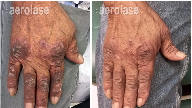 Left hand with skin lesions before and after aerolase laser treatment. Skin discoloration and improvement noted.