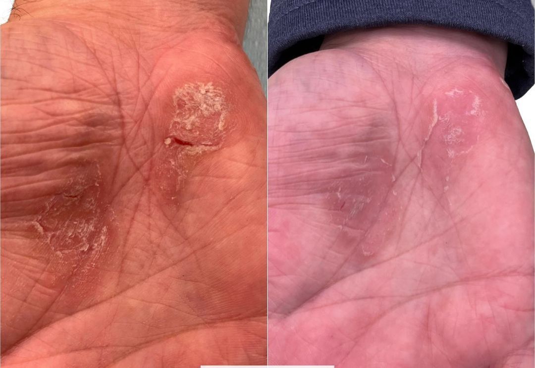Two palms. Left palm has peeling, scaly patches. Right palm shows healing.