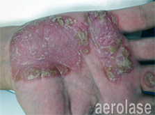 Hand with red, scaly skin and crusty patches, possibly a skin condition.