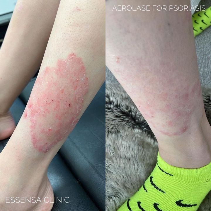 Before and after legs showing psoriasis treatment results using Aerolase.