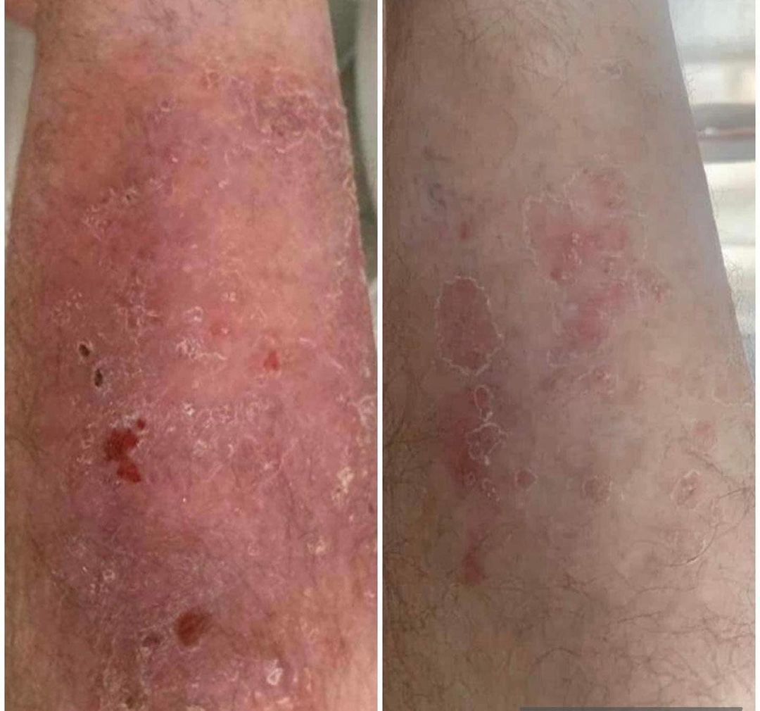 Two images of leg skin with red, scaly patches; left image more severe than right.