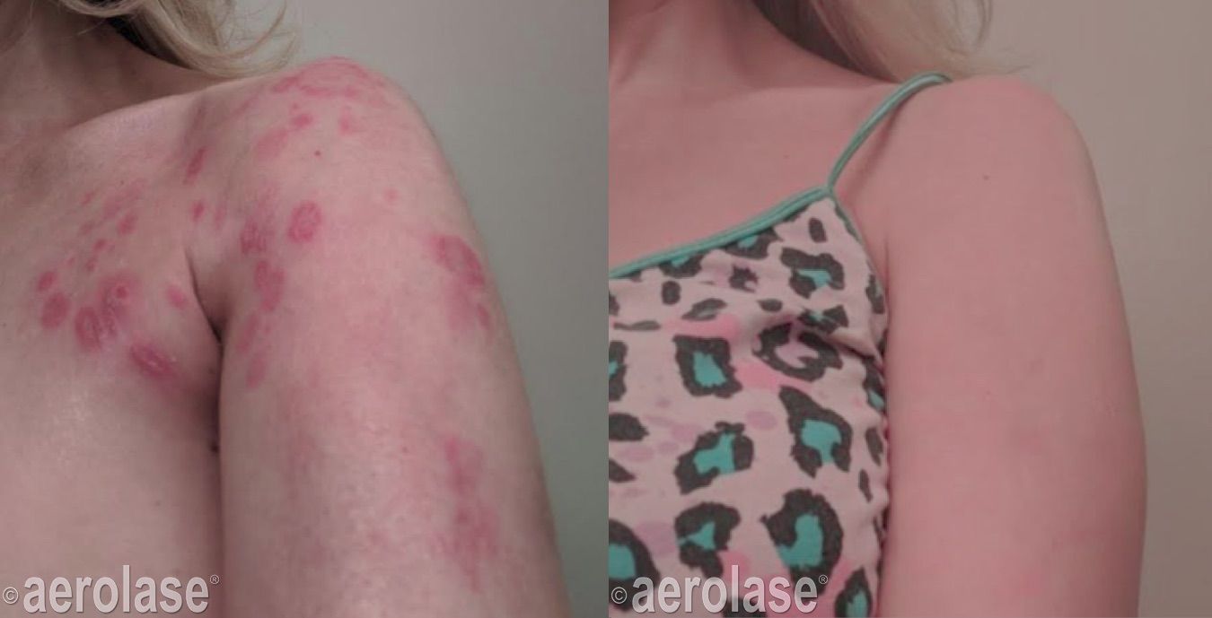 Two images: arm and shoulder with red rash, then clear skin, likely before/after treatment.