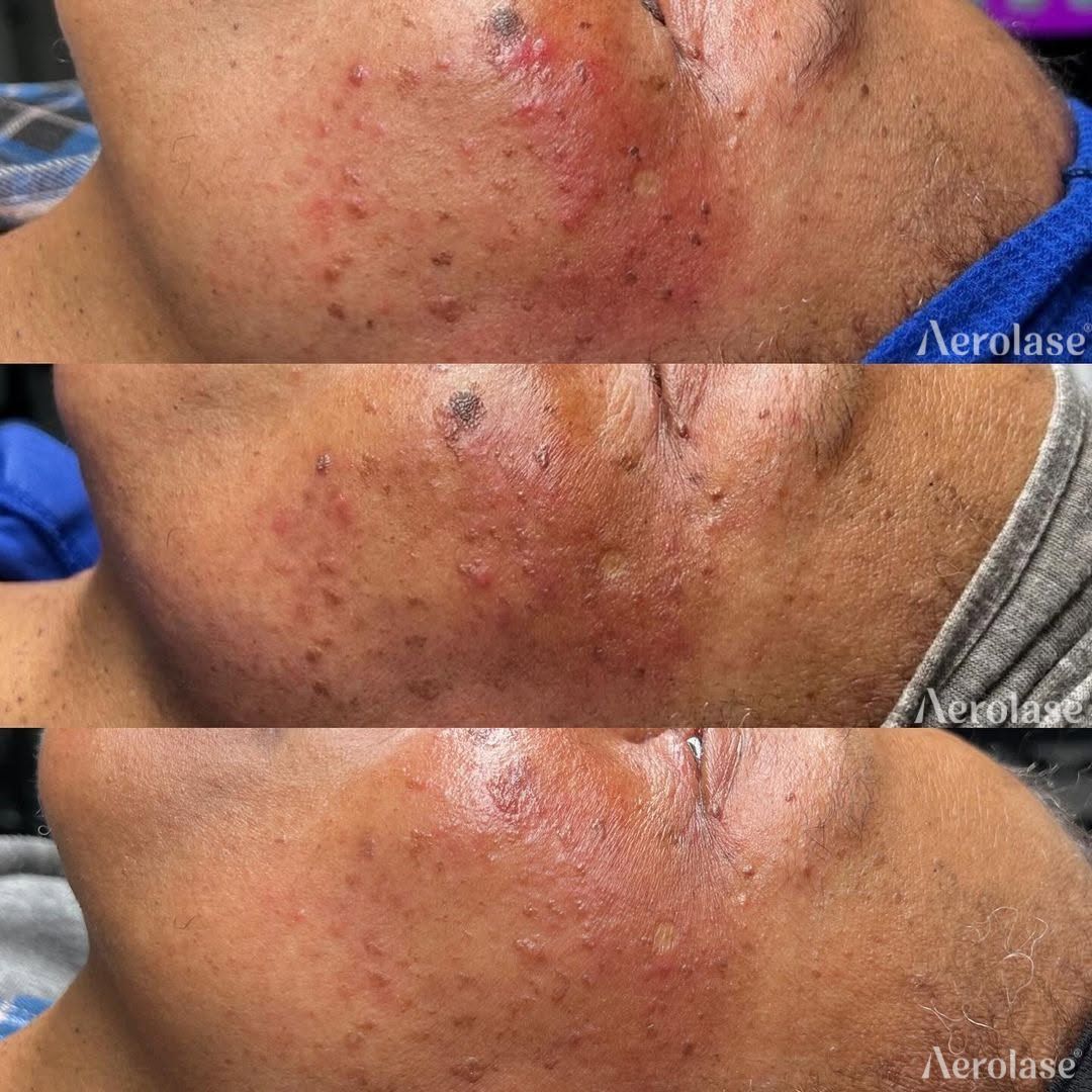 Three photos of a person's jawline showing acne before and after laser treatment, redness and small bumps visible.