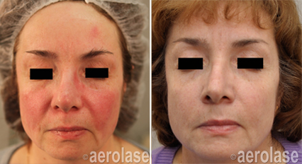 Before and after photos of a person's face; red skin improves, pores and wrinkles are reduced, aerolase logo.