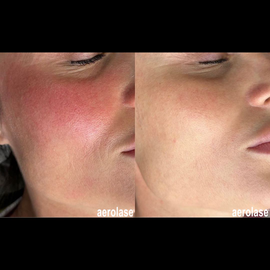 Before-and-after of a person's cheek with rosacea, showing reduction in redness after laser treatment.