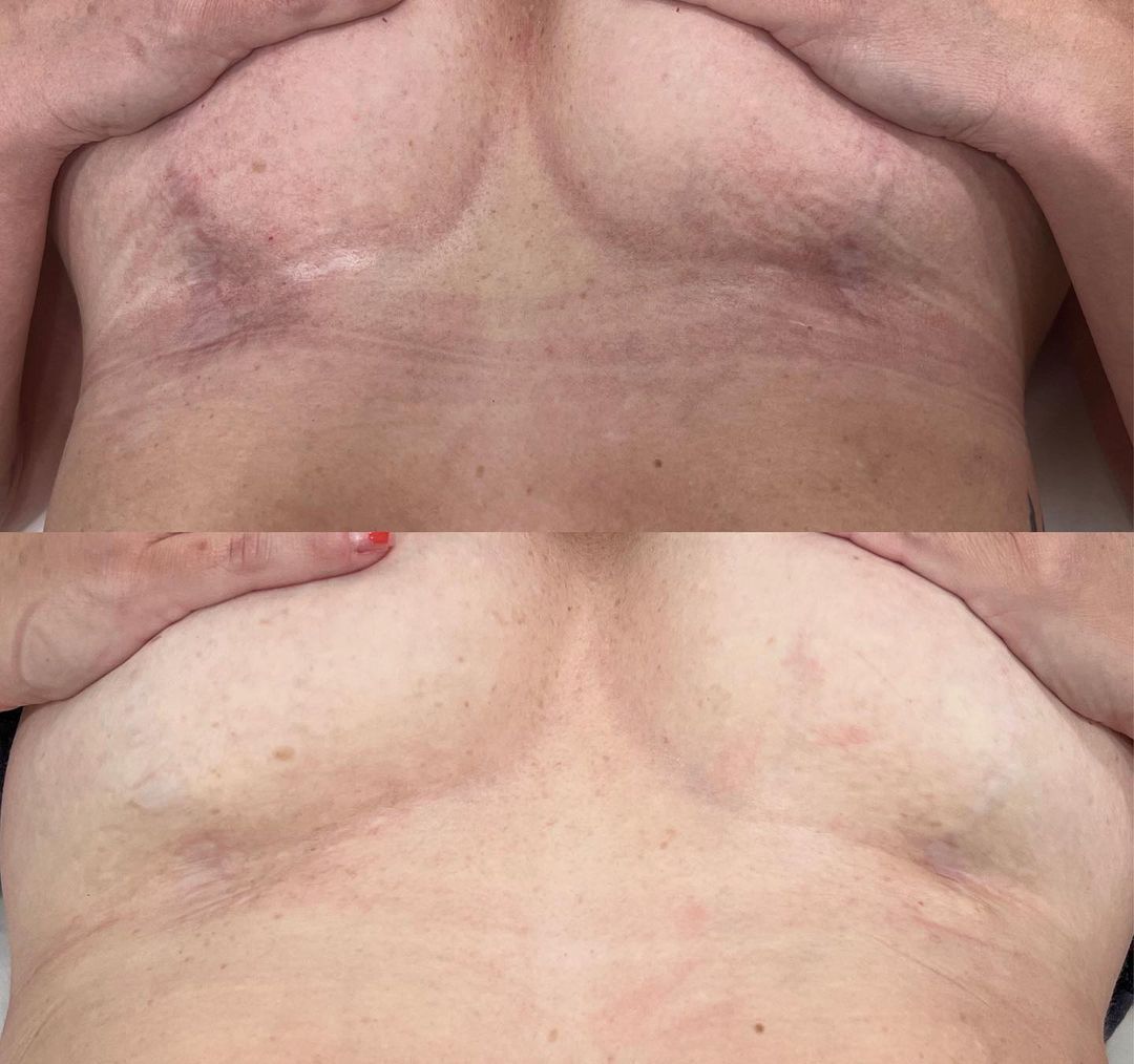 Top: Chest with post-surgery scars. Bottom: Improved chest with reduced scarring.
