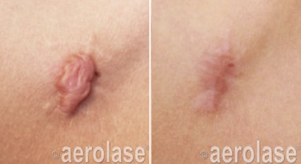 Two images of a skin scar before and after aerolase treatment, showing reduction in size and redness.