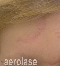 Close-up of a person's face showing skin with slight reddish discoloration. Aerolase logo visible.