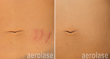 Comparison of skin before and after Aerolase laser treatment for stretch marks on the abdomen.