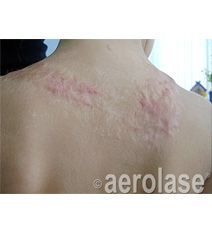 Back of a person with raised, reddish scar tissue across the upper back.