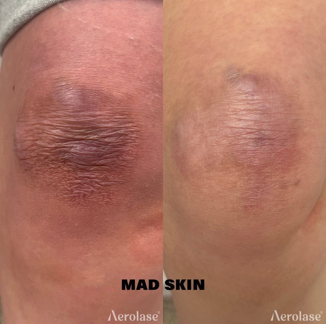 Before and after images of a knee with skin discoloration, likely after laser treatment, showing improvement.
