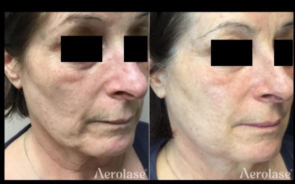 Side-by-side view of a woman's face, before and after a skin treatment. Left side shows more wrinkles. Right side shows improvement.
