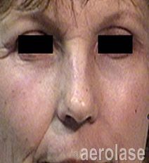 Close-up of a person's face with blacked-out eyes, showing wrinkles and skin texture.