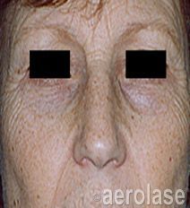 Close-up of a person's face showing wrinkles, age spots, and bags under the eyes. Eyes are blocked out.