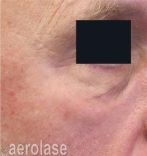 Close-up of skin around an eye with visible wrinkles and redness; a portion is obscured by a black rectangle.