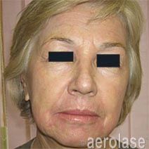 Face of a person with sun-damaged skin, showing wrinkles and redness, likely before a cosmetic procedure.