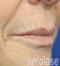 Close-up of human lips with wrinkles and a red spot, likely showing skin treatment before/after.