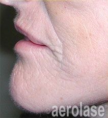 Close-up of a person's mouth and chin, showing wrinkles and skin texture.