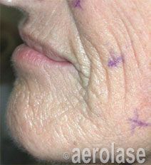 Close-up of a person's mouth and chin, showing skin texture with wrinkles and purple marking dots.