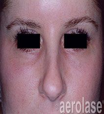 Close-up of a person's face showing skin redness and under-eye discoloration. Aerolase watermark.
