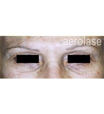 Close-up of eyes, with dark circles and age spots. Eyes are covered with black bars.