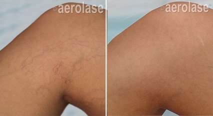 Before and after of knee skin, showing reduction in visible veins after Aerolase laser treatment.