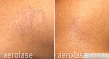Aerolase laser treatment before and after, reducing spider veins on skin.