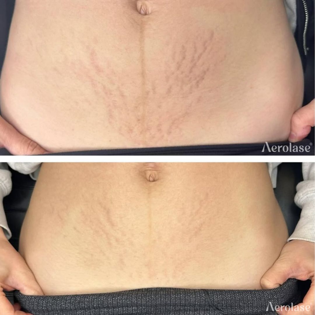 Comparison of an abdomen with stretch marks before (top) and after (bottom) laser treatment.