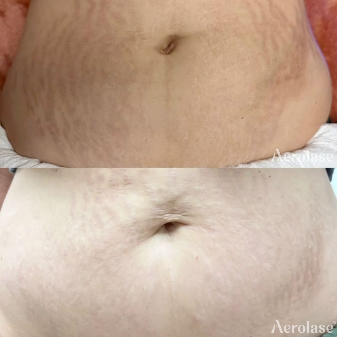 Side-by-side view of a person's abdomen showing stretch marks before and after treatment, reducing their appearance.
