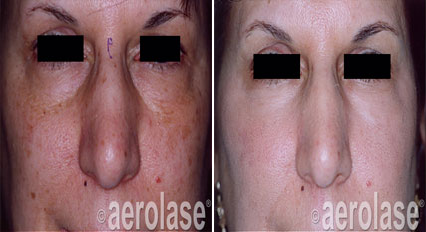 Before and after photos of a nose. Right photo shows smoother skin and reduced discoloration.