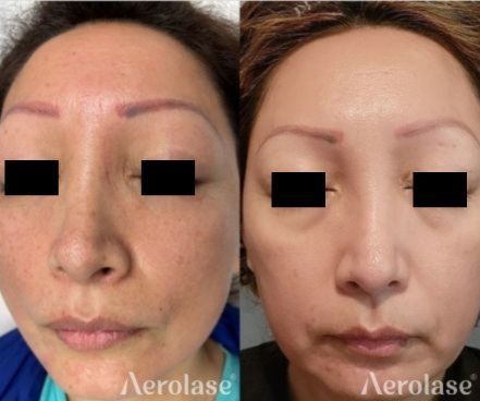Before and after views of a person's face; reduced skin discoloration after laser treatment.