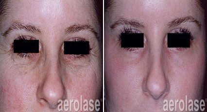 Before and after photos showing reduction of wrinkles around the eyes and improvement in skin tone.