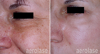 Before-and-after facial skin comparison: Left side has dark spots and discoloration, right side is improved, smoother skin.