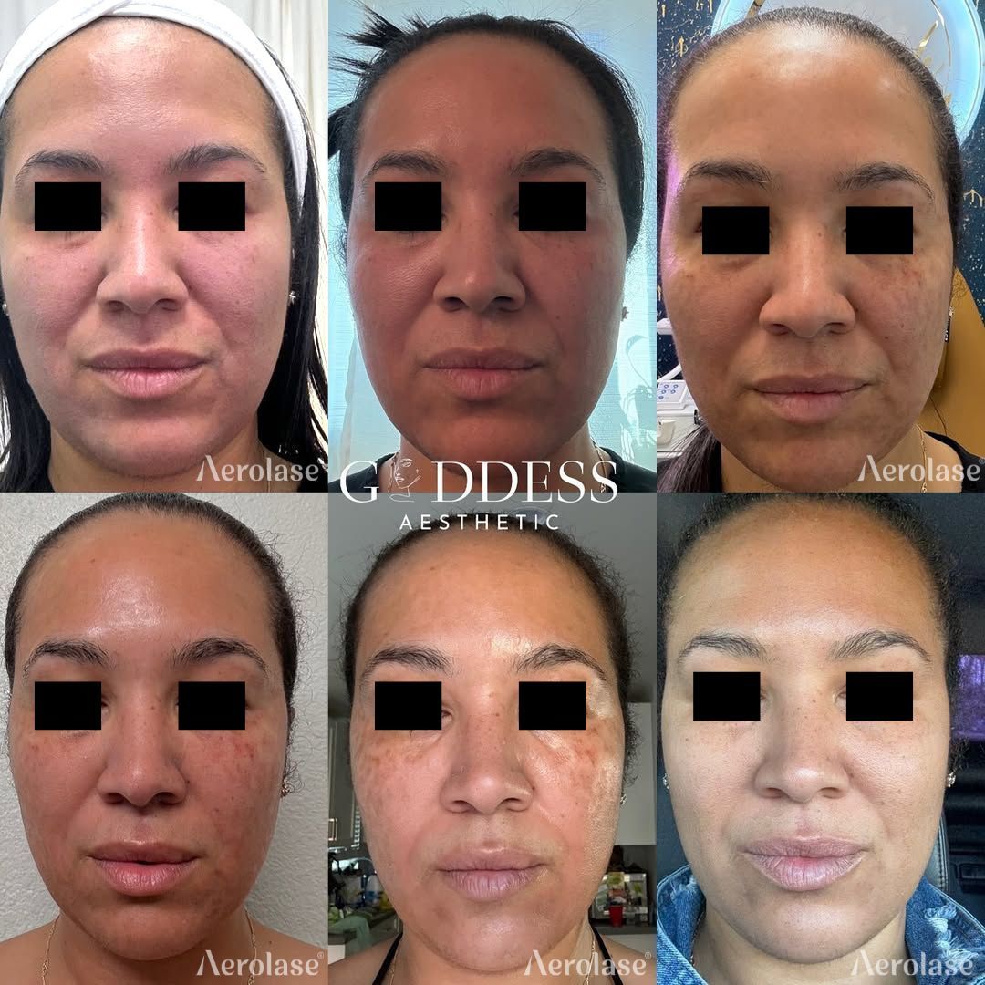 Six photos showing a person's face before and after skin treatment, decreasing redness and discoloration.
